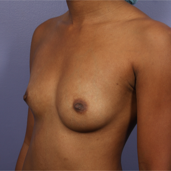 25-34 year old woman treated with Breast Reconstruction before 3226993