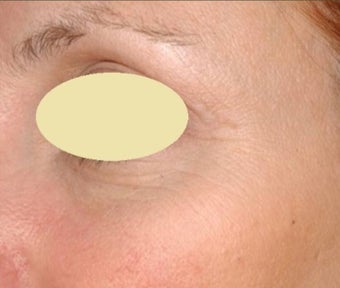 25-34 year old woman treated with Rosacea Treatment after 2975758