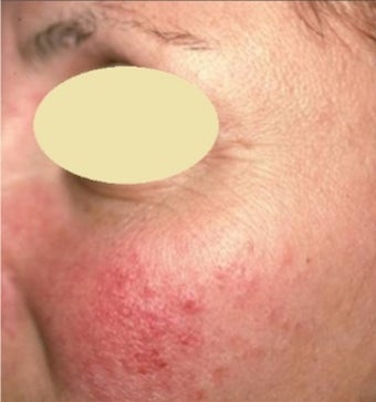 25-34 year old woman treated with Rosacea Treatment before 2975758