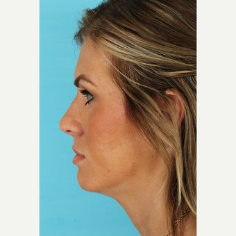 25-34 year old woman treated with Rhinoplasty before 3691003
