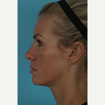 25-34 year old woman treated with Rhinoplasty after 3691003