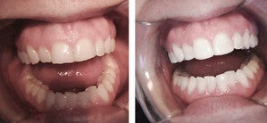 Dental Bridge and Bonding Procedure before 997147