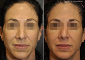 Sculptra before 215961