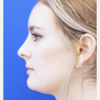 18-24 year old woman treated with Non Surgical Nose Job before 3711507