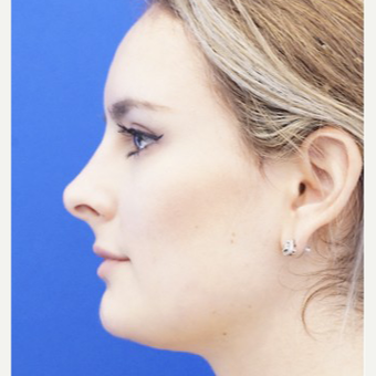 18-24 year old woman treated with Non Surgical Nose Job after 3711507
