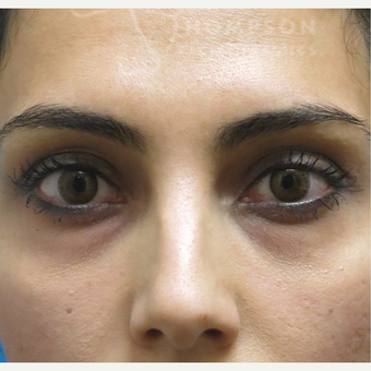 25-34 year old woman treated with Fat Transfer before 3294167