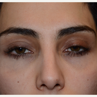 25-34 year old woman treated with Fat Transfer after 3294167