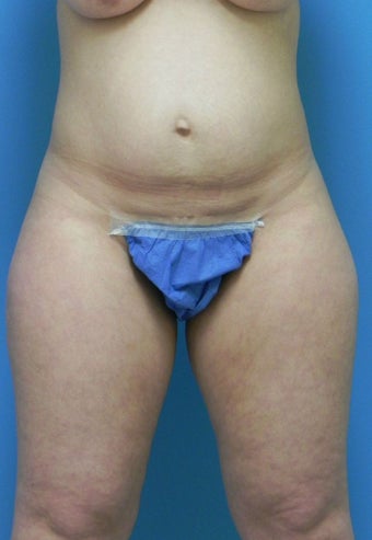37 Year Old Female ~ Abdominoplasty before 1401951