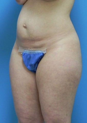 37 Year Old Female ~ Abdominoplasty 1401951