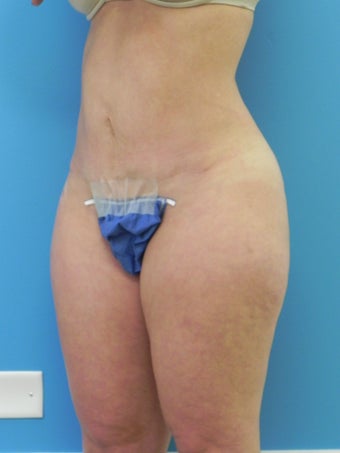 37 Year Old Female ~ Abdominoplasty 1401951