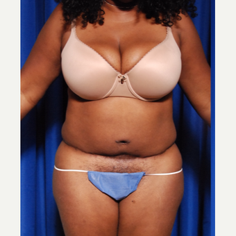 35-44 year old woman treated with Tummy Tuck Revision before 2739537