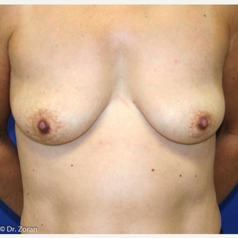 45-54 year old woman treated with Breast Augmentation before 3037389