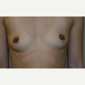25-34 year old woman treated with Breast Implants before 3154125