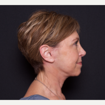 55-64 year old woman treated with Facelift after 3606053