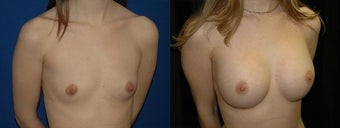 30 year old woman treated with Breast Augmentation before 2990474
