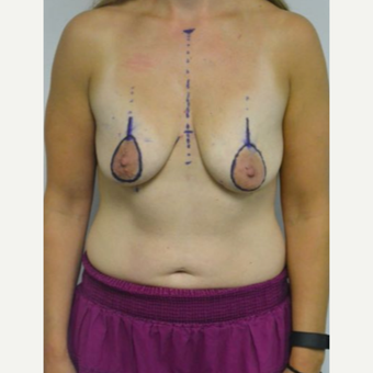 25-34 year old woman treated with Breast Lift with Implants before 3219894