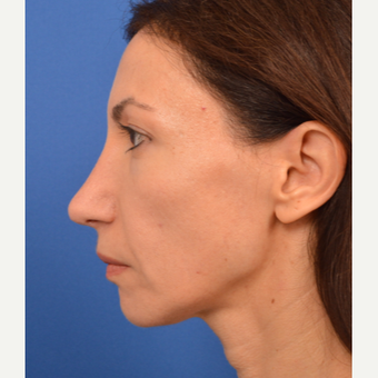 Revision Rhinoplasty after 3220615