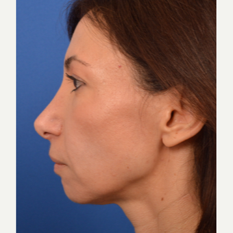 Revision Rhinoplasty before 3220615