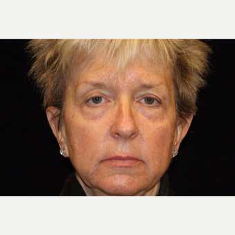 55-64 year old woman treated with Liquid Facelift before 3502656