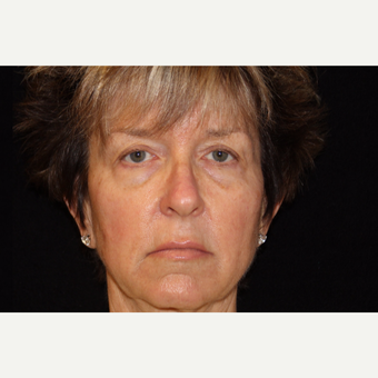 55-64 year old woman treated with Liquid Facelift after 3502656