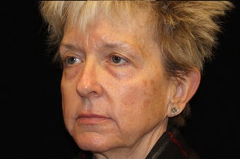 55-64 year old woman treated with Liquid Facelift 3502656