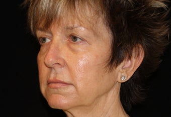 55-64 year old woman treated with Liquid Facelift 3502656