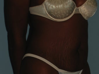 Patient underwent an Abdominoplasty 987565