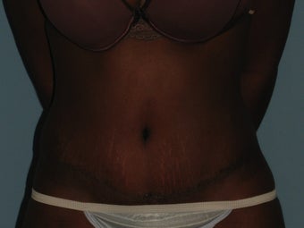 Patient underwent an Abdominoplasty after 987565