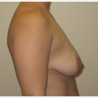 25-34 year old woman treated with Breast Augmentation before 3423797