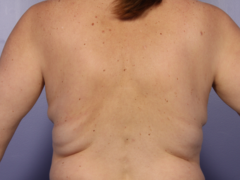 Zeltiq CoolSculpting 296205