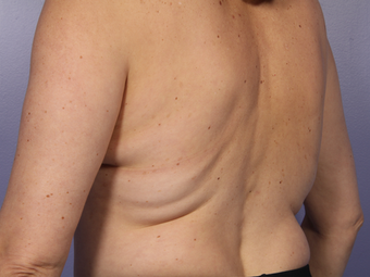 Zeltiq CoolSculpting before 296205