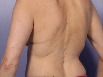 Zeltiq CoolSculpting after 296205
