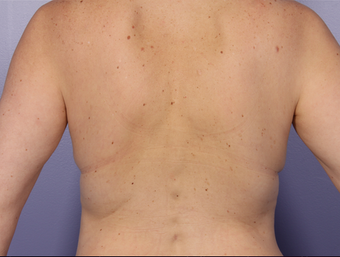 Zeltiq CoolSculpting 296205