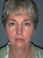 65-74 year old woman treated with Neck Lift before 3103894