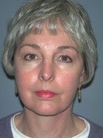 65-74 year old woman treated with Neck Lift after 3103894