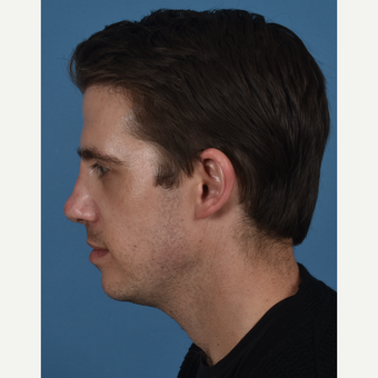 25-34 year old man treated with Revision Rhinoplasty after 3437384