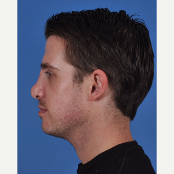 25-34 year old man treated with Revision Rhinoplasty before 3437384