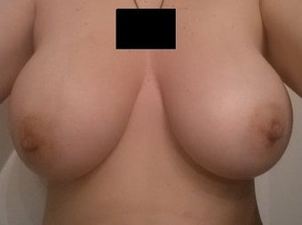 39 yo woman who underwent Mini UBL with implant removal before 1268928
