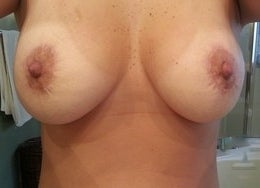 39 yo woman who underwent Mini UBL with implant removal after 1268928