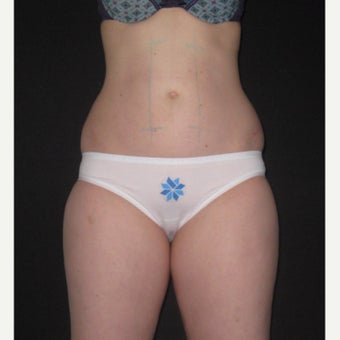 25-34 year old woman treated with CoolSculpting. Abdomen, flanks and inner thighs before 2218494