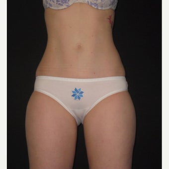 25-34 year old woman treated with CoolSculpting. Abdomen, flanks and inner thighs after 2218494
