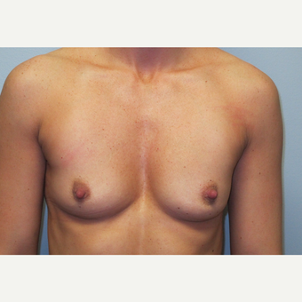 35-44 year old woman treated with Breast Augmentation before 3185751