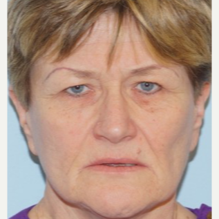 55-64 year old woman treated with Brow Lift before 3727783
