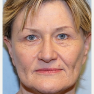 55-64 year old woman treated with Brow Lift after 3727783