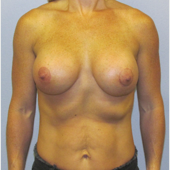 35-44 year old woman treated with Breast Lift with Implants after 3762271