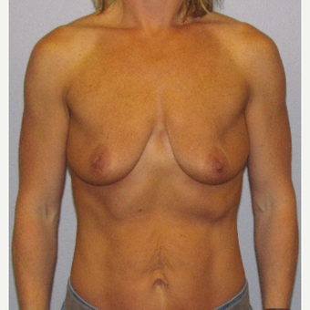 35-44 year old woman treated with Breast Lift with Implants before 3762271