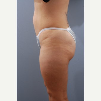 35-44 year old woman treated with Tummy Tuck before 3590141