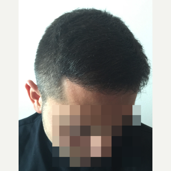 26 years old man treated with FUE Hair Transplant after 3068899