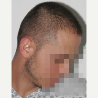 26 years old man treated with FUE Hair Transplant before 3068899