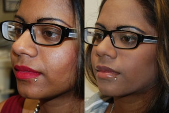 Silikon-1000 lip augmentation. before 1414640